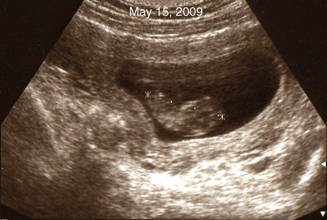 9.2_090530.jpg - First trimester sonogram, May, 2009